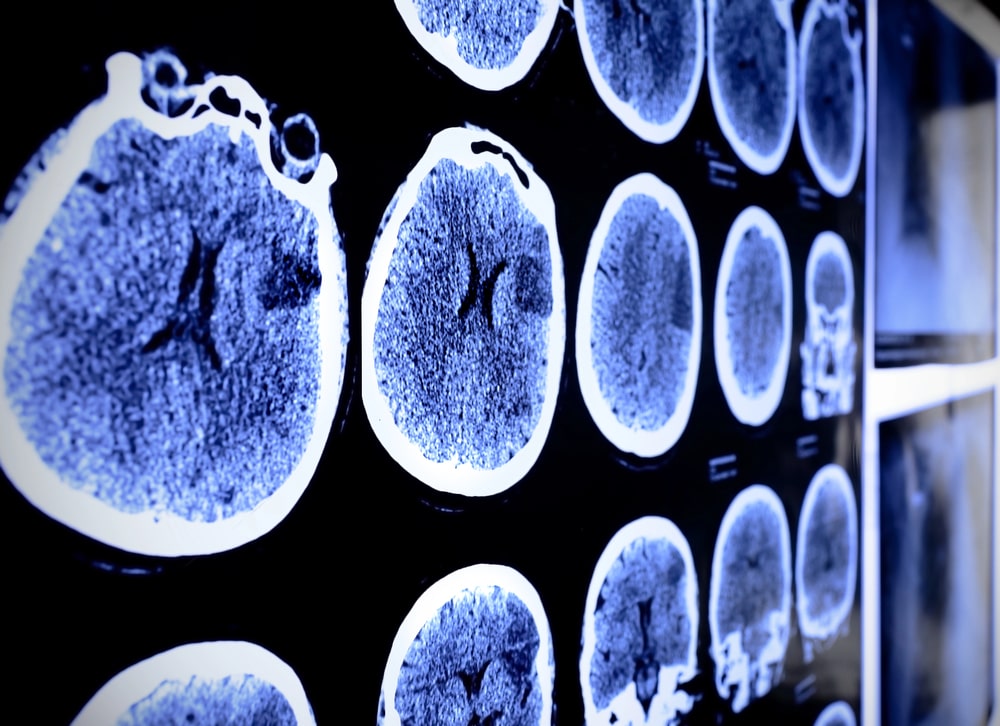 When To Seek Legal Help For A Brain Injury Claim